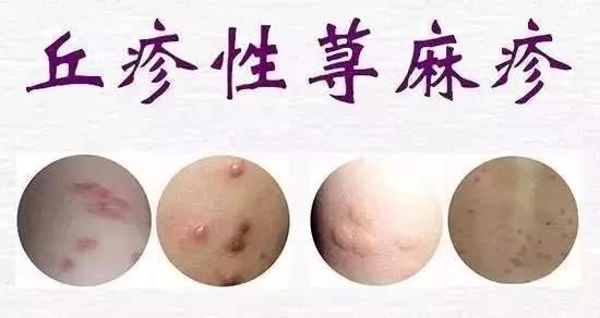 四个月的宝宝被蚊子咬了应该如何处理？